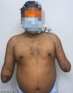 12 hour Double Arm Transplant A Success 